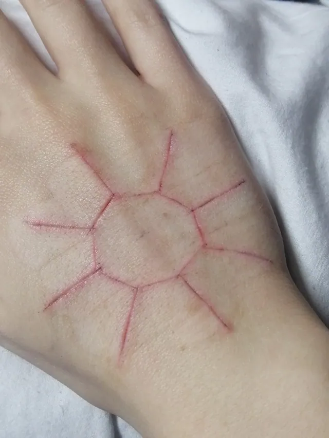 The back of Liz’s hand with a healed scar shaped like a sun